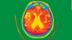 5 cosas que no sabías sobre el Alzheimer.