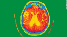 5 cosas que no sabías sobre el Alzheimer.