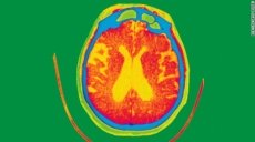 5 cosas que no sabías sobre el Alzheimer.