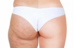 Automasaje para eliminar la celulitis