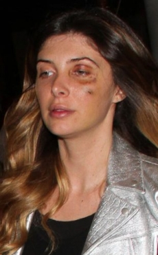 Brittny Gastineau, la amiga de Kim Kardashian, apareció con un ojo morado
