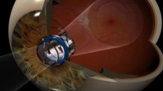 Crean un telescopio ocular para devolver la visión a personas con degeneración macular