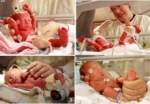 Cuatrillizas idénticas sorprenden a madre que esperaba trillizas