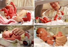 Cuatrillizas idénticas sorprenden a madre que esperaba trillizas