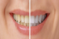 Dientes amarillos: Conoce las causas y trucos para blanquearlos