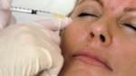 El Botox puede ser una nueva forma de tratar el cáncer, dice un estudio