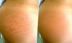 ELIMINA LAS ESTRÍAS DE TU CUERPO PARA SIEMPRE CON ESTE SENCILLO REMEDIO CASERO