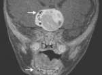 Hallan dientes en el cerebro de un bebé