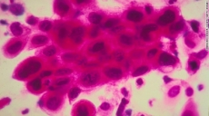 La mayoría de los cánceres de la actual pandemia mundial se pueden prevenir