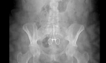 Mujer lleva por 9 meses unas tijeras en su vientre por error médico