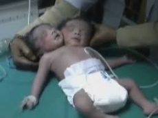 Nacen Siameses con un sólo cuerpo y dos cabezas en la India