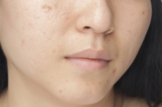 Remedios caseros para las manchas de la cara.