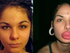 Rusa se ha operado 100 veces para tener labios más grande del mundo