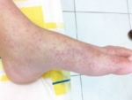Salud Pública no sabe si fiebre es la Chikungunya
