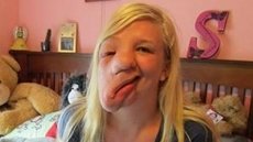 Sarah Atwell, la joven sin rostro, recupera la sonrisa