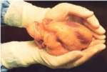 Trasplantan por primera vez un corazón artificial con tejidos biológicos